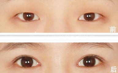 如何双眼皮手术的安心性