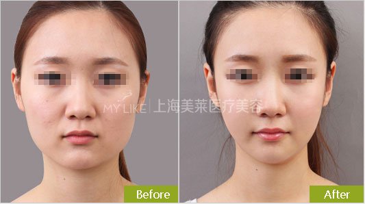 botox瘦脸的三大常识