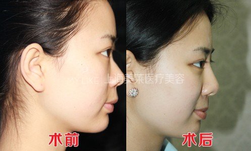 想要容貌焕然一新,20、30、40岁如何微调?