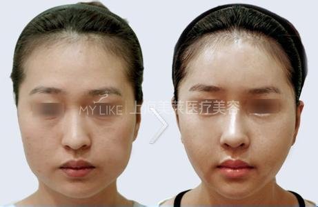 想要容貌焕然一新,20、30、40岁如何微调?