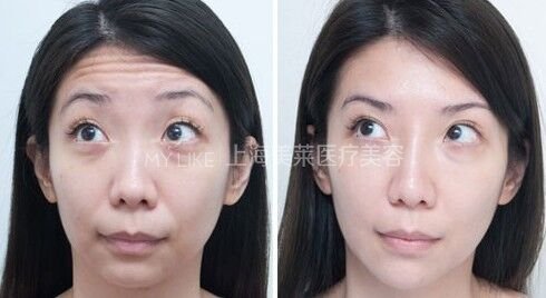 想要容貌焕然一新,20、30、40岁如何微调?