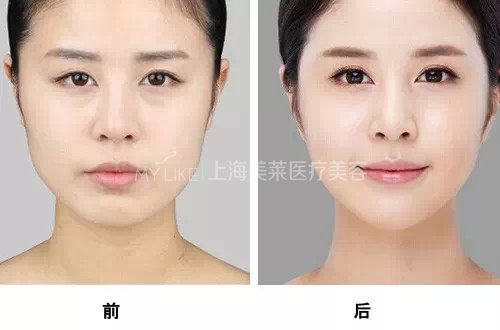 想要容貌焕然一新,20、30、40岁如何微调?